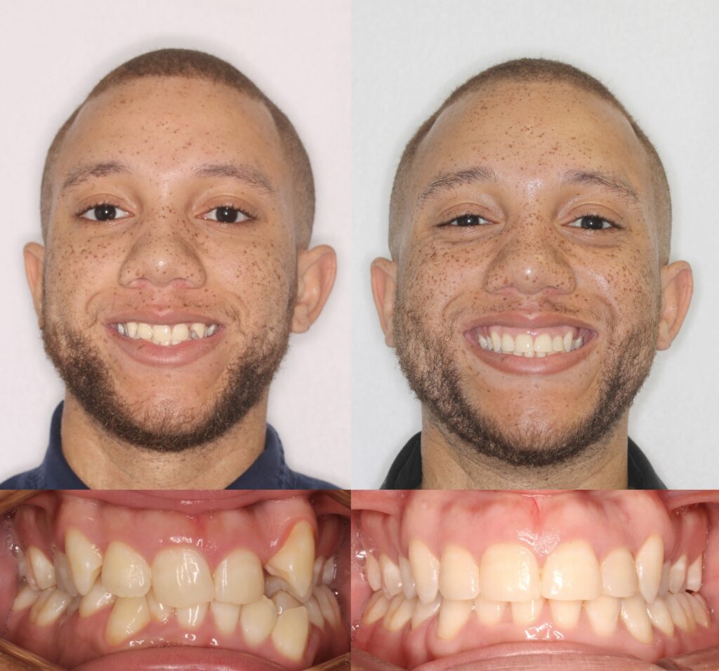 Before & Afters - Anthony